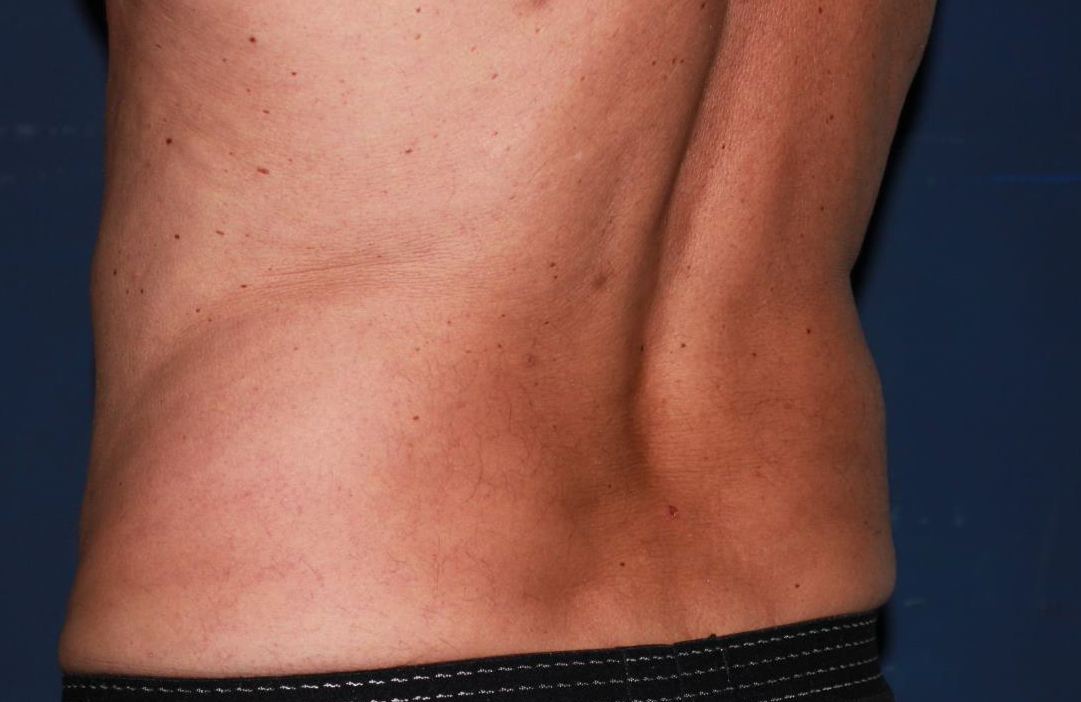 Miradry : La Solution Révolutionnaire contre l’Hyperhidrose