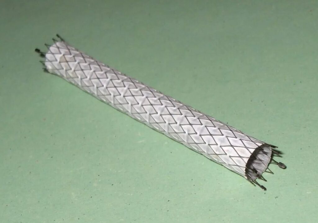 Combien de stents peut-on recevoir ? Découvrez les limites et les possibilités de la procédure.