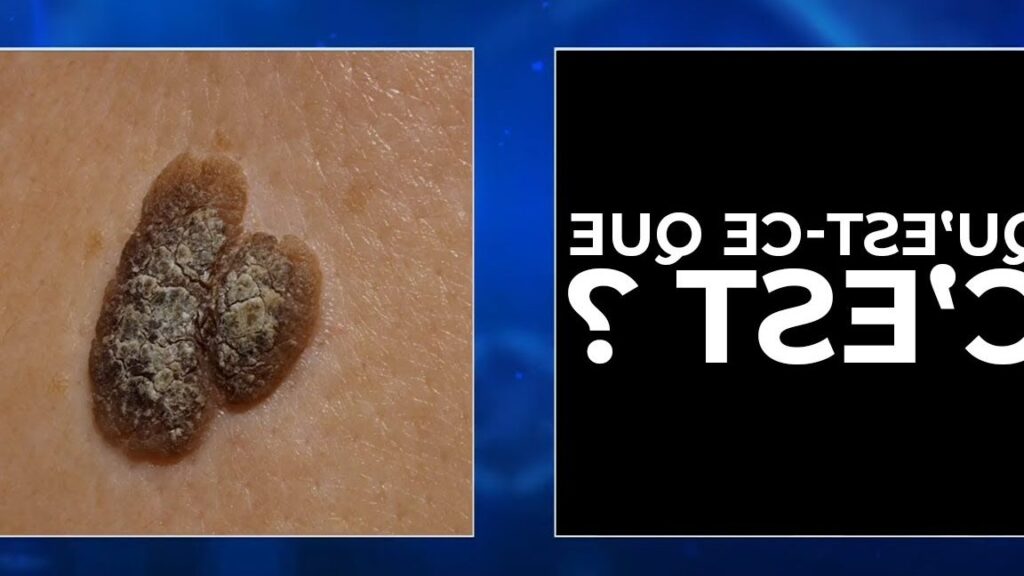 Comment gratter un grain de beauté sans danger ?