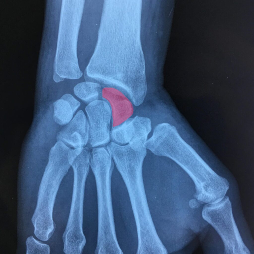 Comment soulager une tendinite de manière naturelle ?