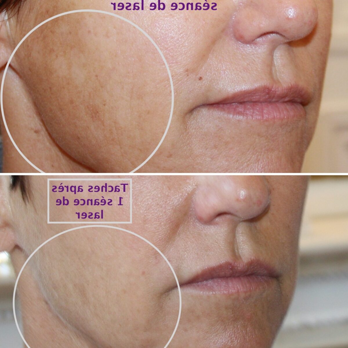 Comment traiter les taches brunes post-acnéiques : Solutions et préventions