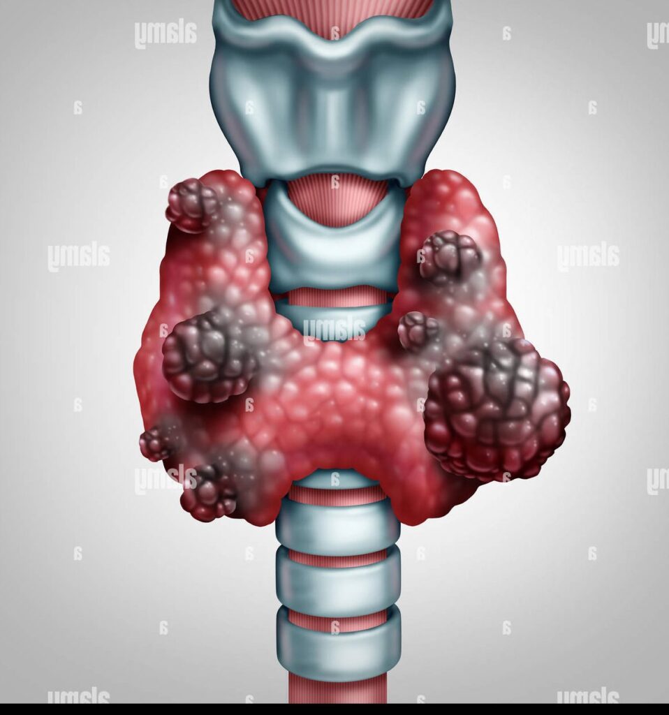 Comprendre le Cancer de la Thyroïde Stade 5 : Symptômes, Traitements et Perspectives