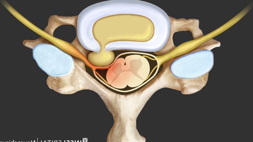 Comprendre le Débord Discal Foraminal : Causes, Symptômes et Traitements
