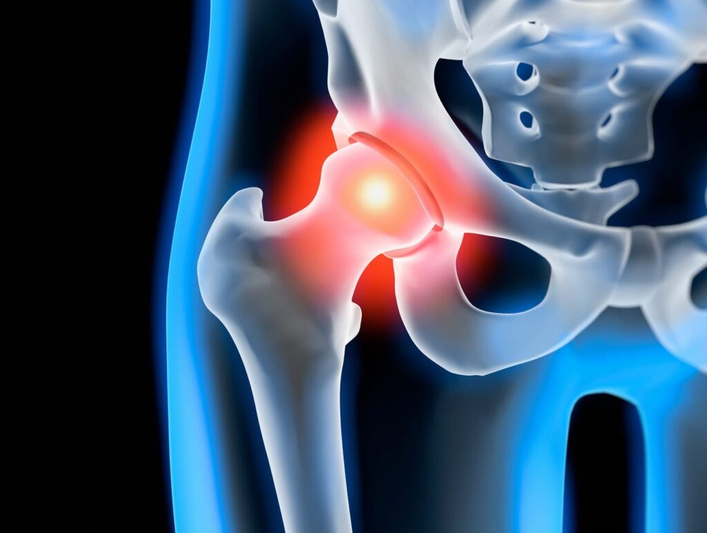 Coxarthrose Avancée: Comprendre et Gérer le Stade 5 de l&rsquo;Arthrose de la Hanche
