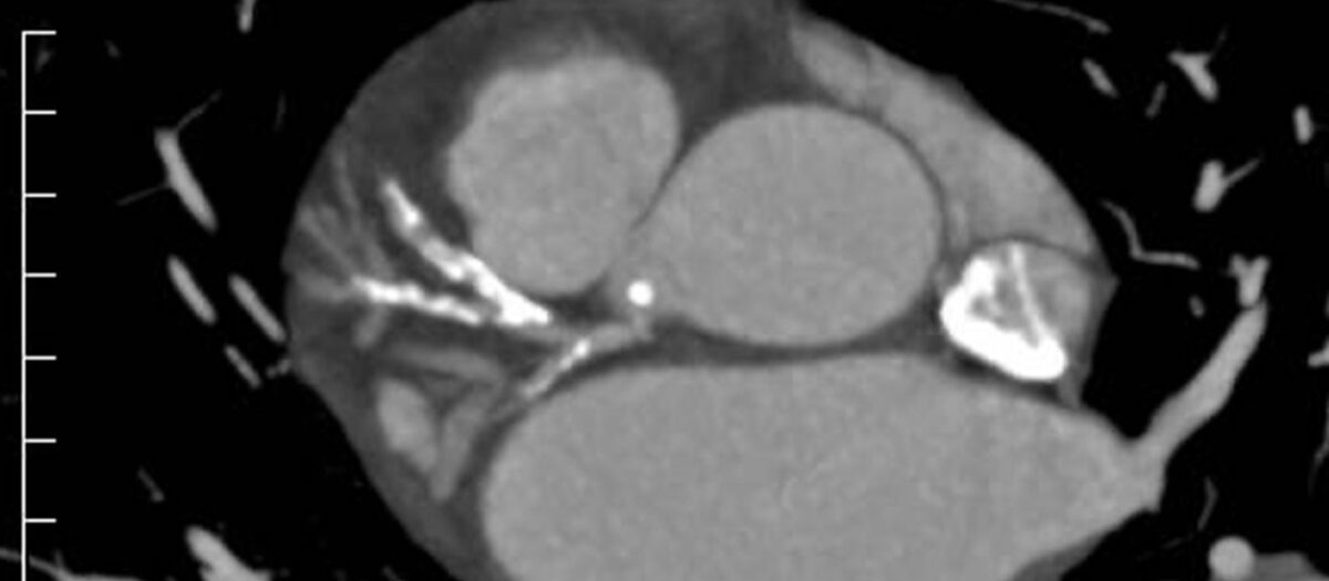 La Cornographie: Comprendre l&rsquo;Impact de la Surconsommation Alimentaire sur la Santé Publique
