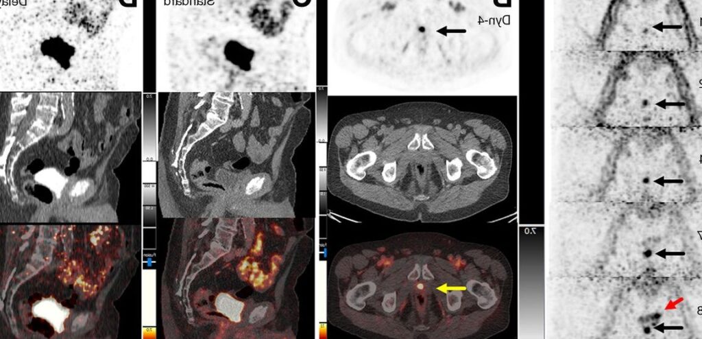 TEP Choline et Diagnostic de Prostate: Avancées et Perspectives