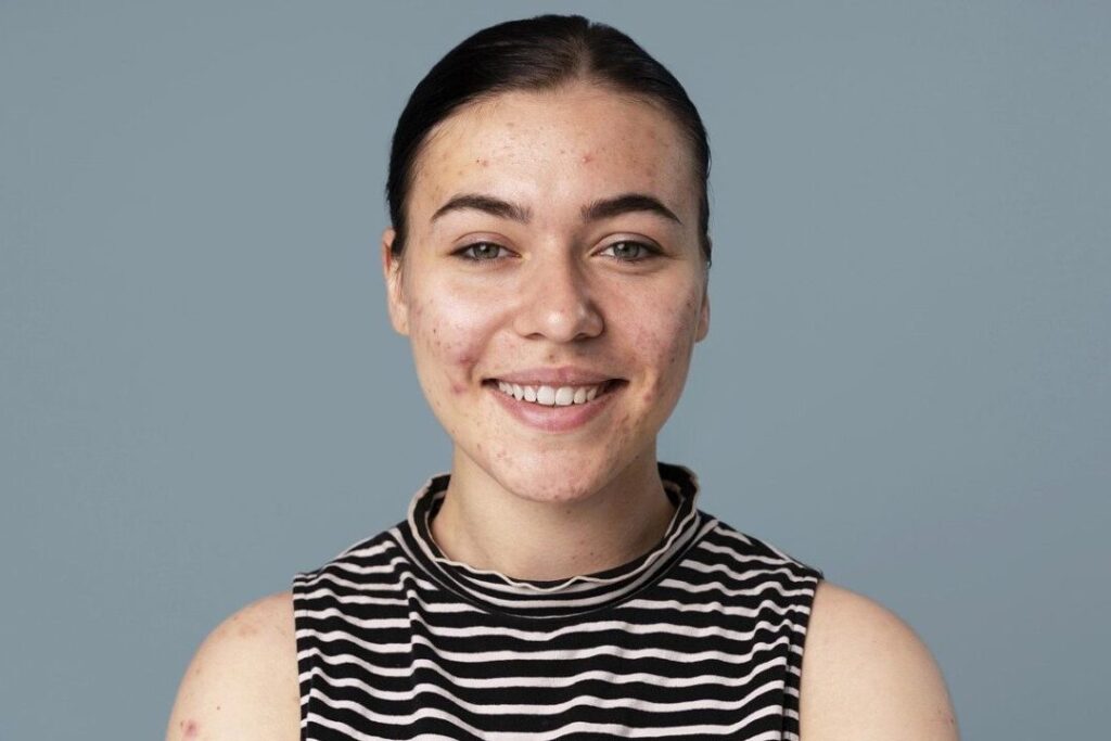 Comment faire mûrir un bouton rapidement : Astuces et Conseils