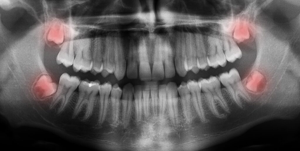 Comment traiter efficacement la calcification du supra-épineux : Guide complet sur les thérapies actuelles