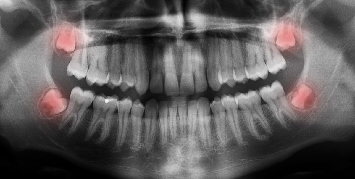 Comment traiter efficacement la calcification du supra-épineux : Guide complet sur les thérapies actuelles