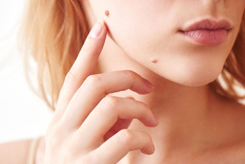 Comment traiter un grain de beauté sec au toucher ?