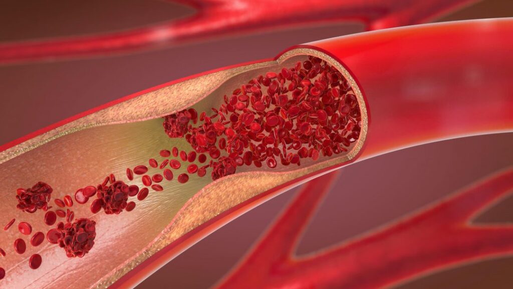 Comprendre l&rsquo;athérome calcifié non sténosant : Implications pour votre santé vasculaire