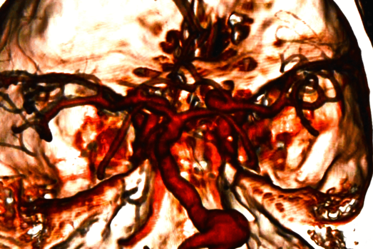 Convalescence après une opération du canal carpien : Conseils pour une récupération optimale