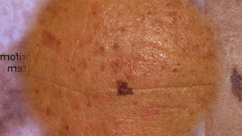 Mélanonychie : Comprendre et Identifier les Causes de Ces Rayures Mystérieuses sur Vos Ongles