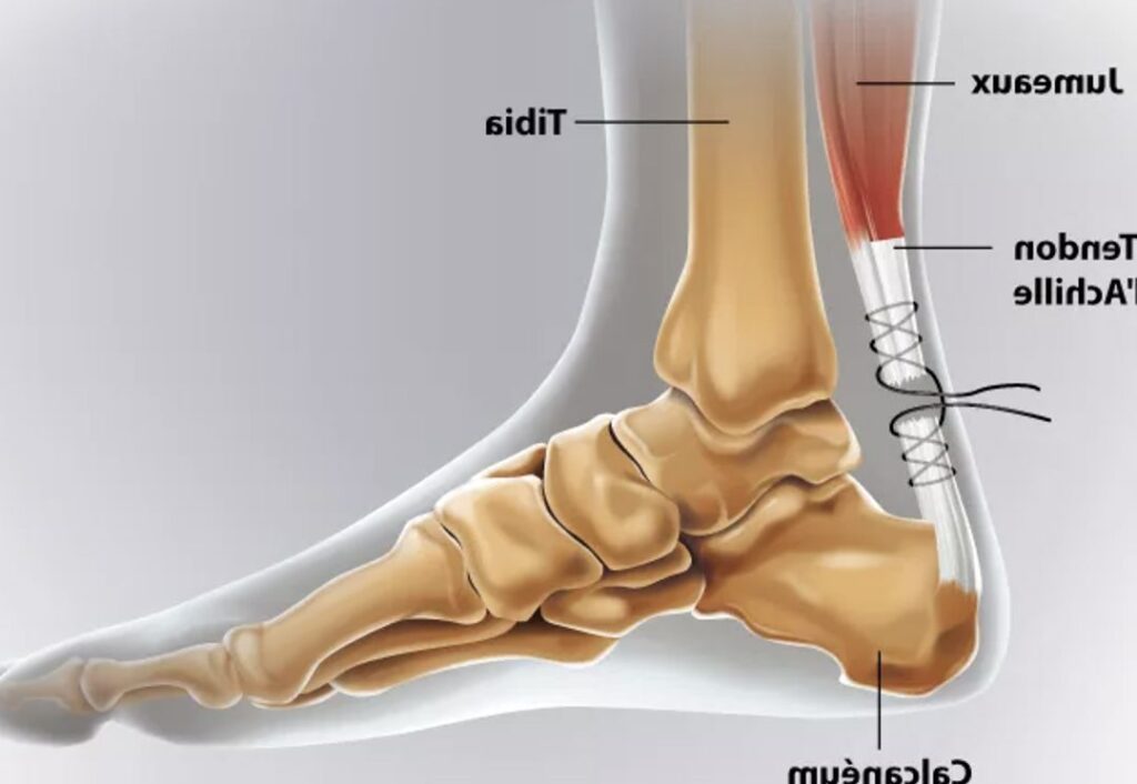 Rupture du tendon d&rsquo;Achille : Comprendre, Prévenir et Traiter