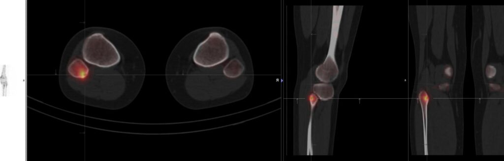 Scintigraphie osseuse : Comprendre son rôle dans le diagnostic et le suivi de l’arthrose