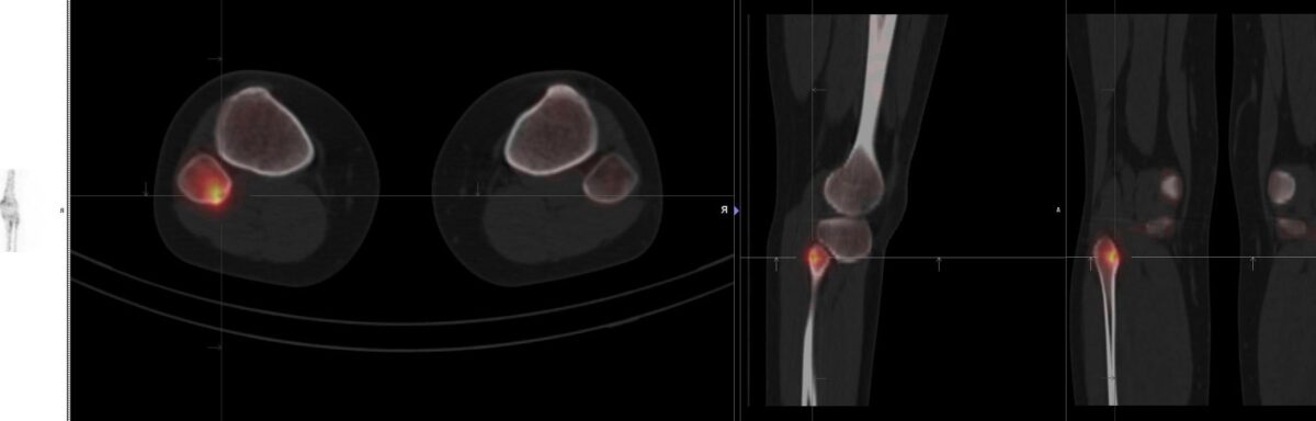 Scintigraphie osseuse : Comprendre son rôle dans le diagnostic et le suivi de l’arthrose