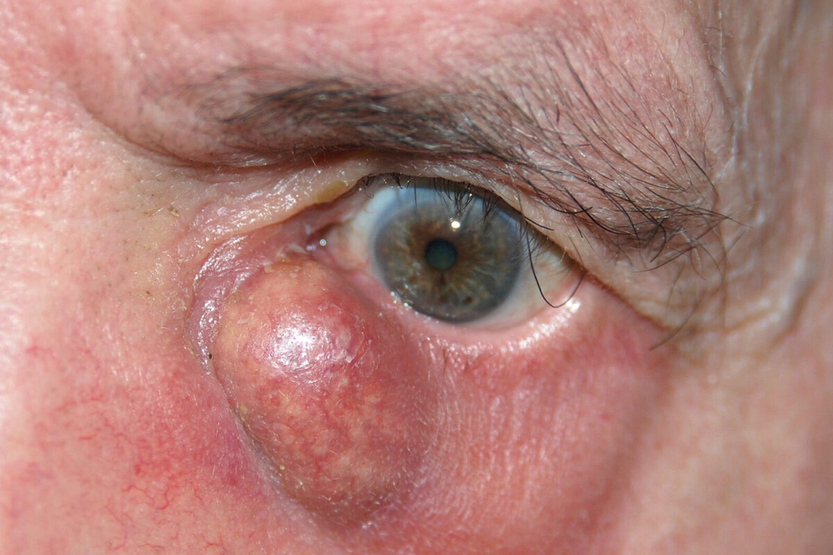 Comprendre les Tumeurs de la Paupière : Identification et Implications à Travers des Photos Éducatives