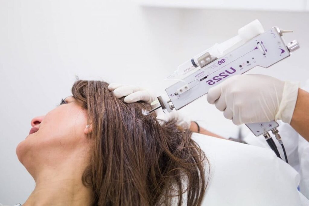 Traitements efficaces pour combattre la pelade de la barbe : retrouver une pilosité saine